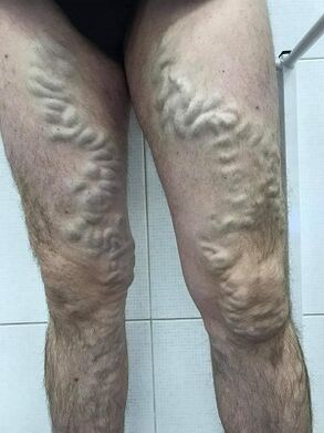 សរសៃ varicose បុរសដែលមិនយកចិត្តទុកដាក់