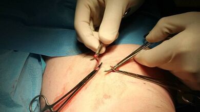 flebectomy សម្រាប់សរសៃឈាមវ៉ែនតា