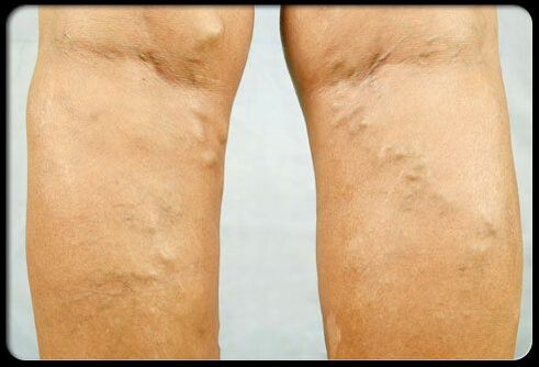 សរសៃ varicose នៅលើជើង