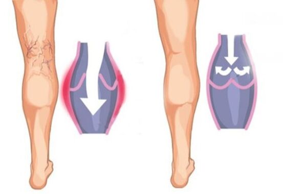 អ្វីដែលសរសៃ varicose មើលទៅដូច