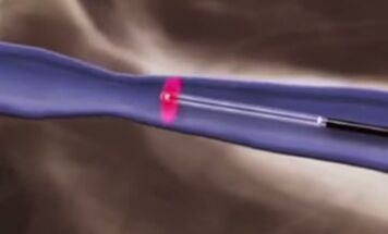 ការព្យាបាលកំដៅ