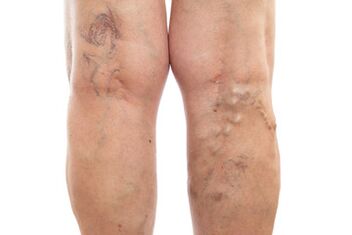 សរសៃ varicose នៃចុងទាបបំផុត។